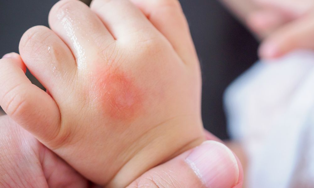 Vết muỗi đốt phồng rộp trên tay trẻ sơ sinh