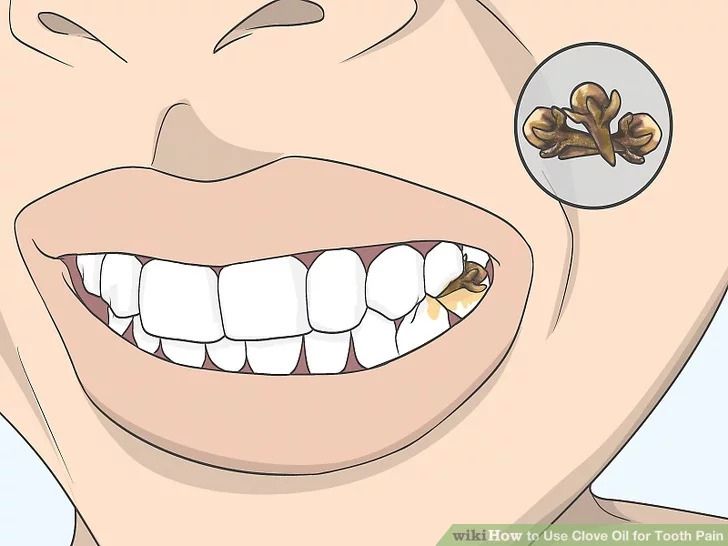 Cách giảm đau răng bằng nụ đinh hương